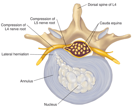 Herniated disc drawing