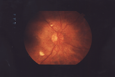 Proliferative Diabetic Retinopathy